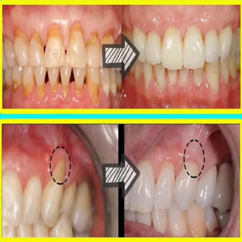 Quickly Repair Gum Serum Relie - огляд і ціна Teeth Whitening With Baking Soda