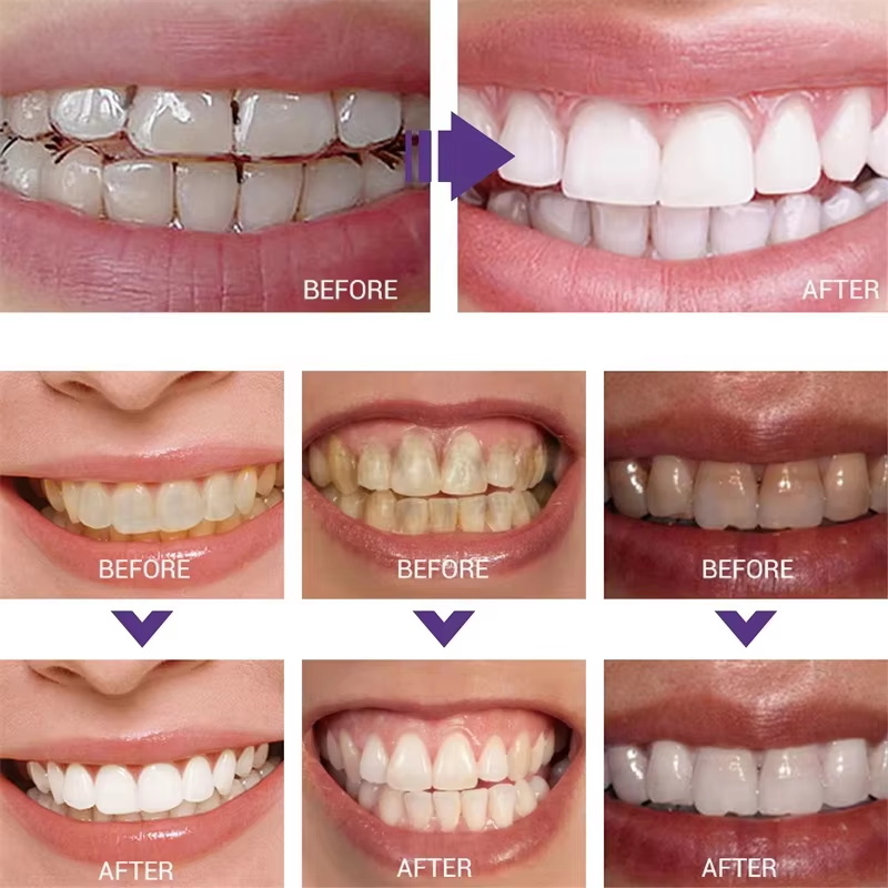 Teeth Cleansing Whitening Toot - огляд і ціна Teeth Whitening Korea