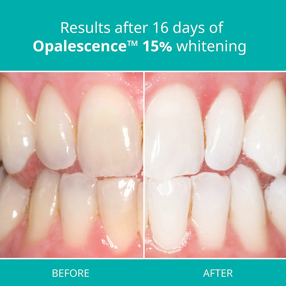 Opalescence Professional White - огляд і ціна Teeth Whitening Gel Opalescence