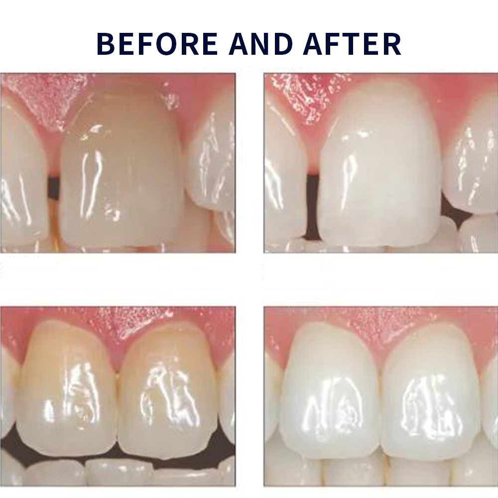 Opalescence Whitening 20% PF 2 - огляд і ціна Teeth Whitening Foam