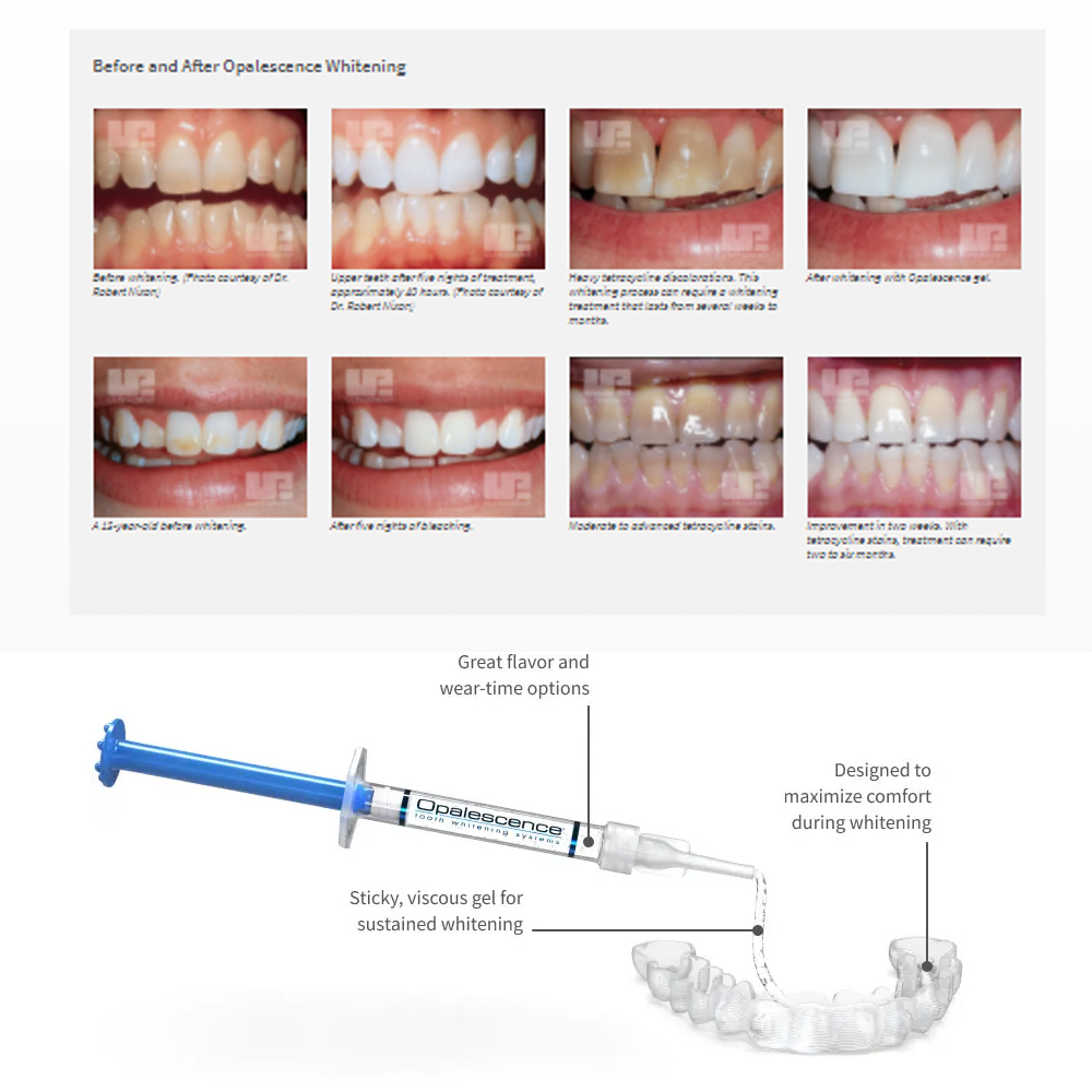 Opalescence Whitening 20% PF 2 - огляд і ціна Teeth Whitening Foam