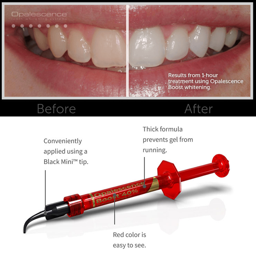 Ultradent Opalescence Boost PF - огляд і ціна Teeth Whitening Gel Opalescence